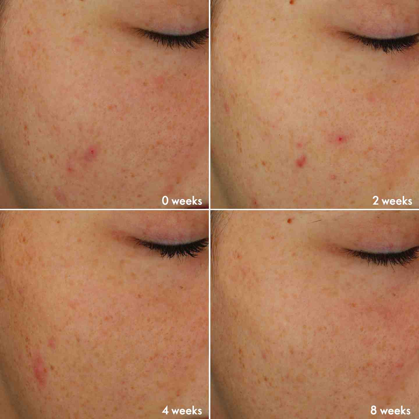 ست محصولات ضد جوش بلمیش ایج دیفای نوایج پلاس اوریفلیم